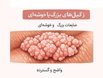 زگیل‌های بزرگ یا خوشه‌ای