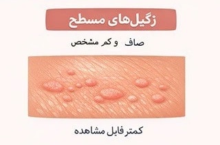 زگیل‌های مسطح