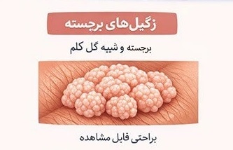 زگیل‌های برجسته