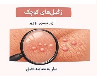 زگیل‌های کوچک (Micropapular warts)