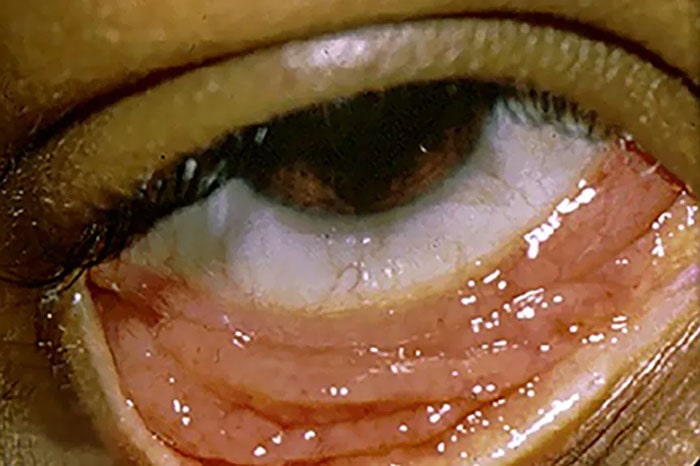 کلامیدیا (Chlamydia)