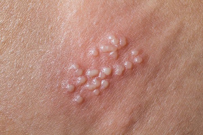 هرپس تناسلی (Genital Herpes)