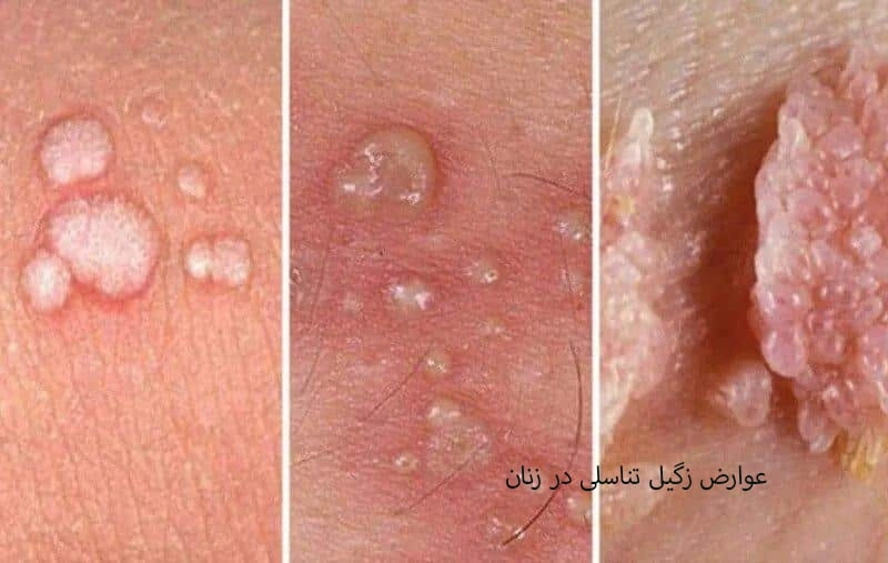 زگیل تناسلی در زنان چه عوارضی دارد؟