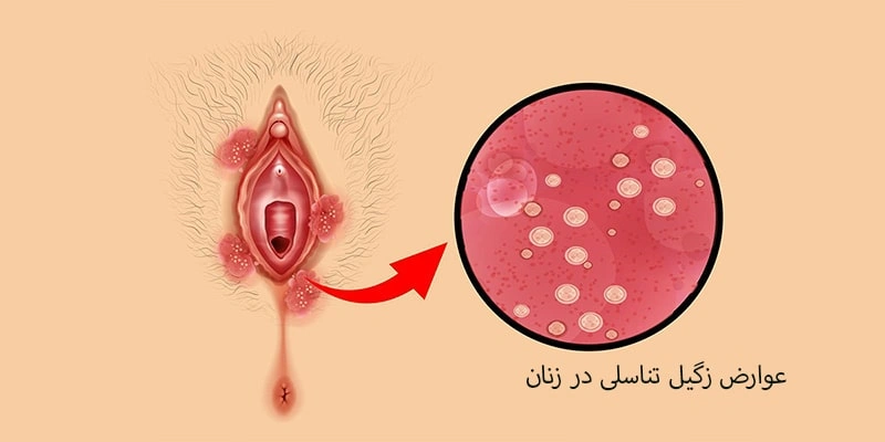 زگیل تناسلی در زنان چه عوارضی دارد؟