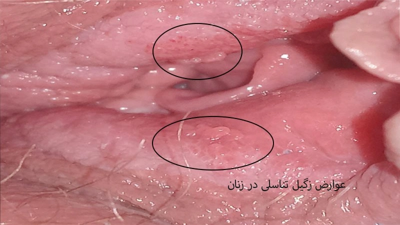 زگیل تناسلی در زنان چه عوارضی دارد؟
