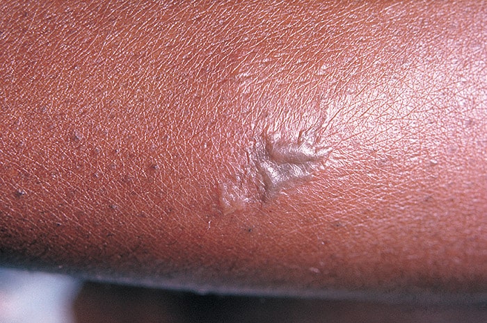 سوزاک (Gonorrhea)