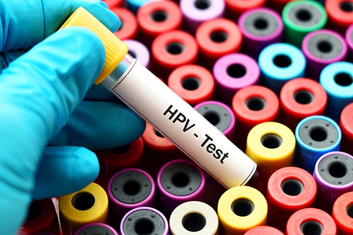 آزمایش HPV یا زگیل تناسلی