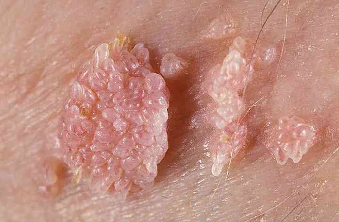 زگیل تناسلی (HPV)