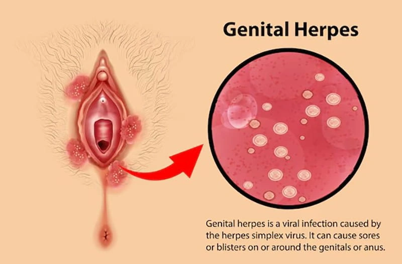 طول عمر ویروس زگیل تناسلی HPV