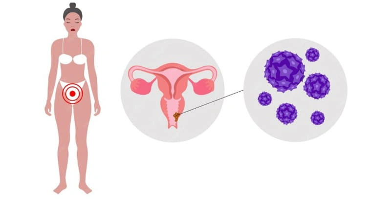 طول عمر ویروس زگیل تناسلی HPV