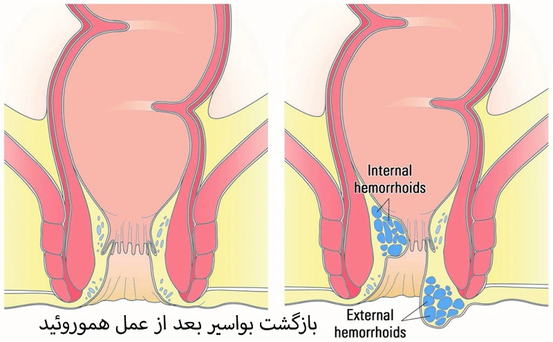 بازگشت بواسیر بعد از عمل هموروئید ممکن است؟