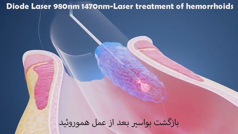 زگیل تناسلی چه بازگشت بواسیر بعد از عمل هموروئید ممکن است؟ 