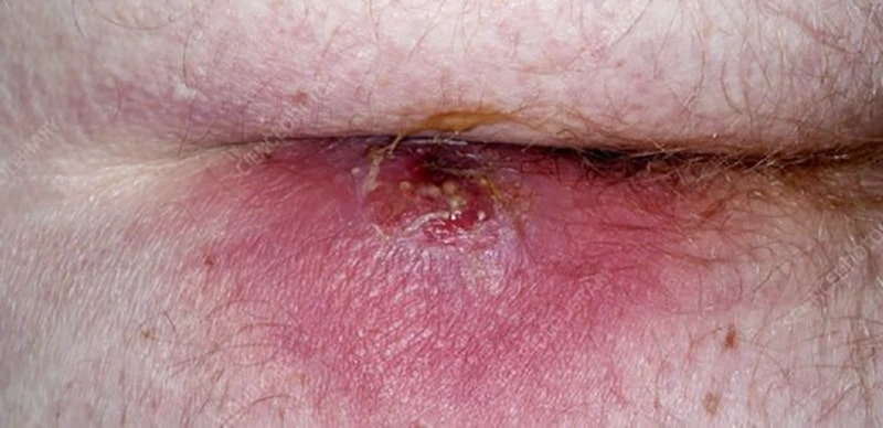 عمل تخلیه آبسه مقعدی چگونه انجام میشود؟