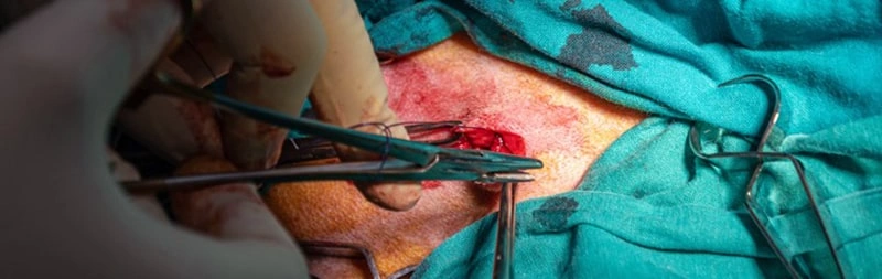 عمل تخلیه آبسه مقعدی چگونه انجام میشود؟