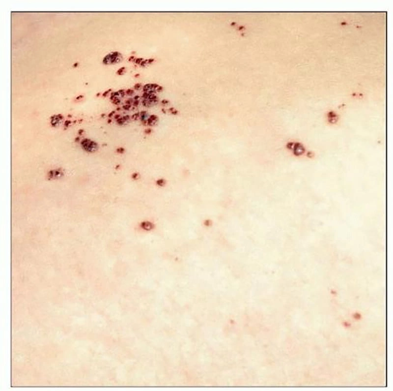 آنژیوکراتوم چیست و چه تفاوتی با زگیل تناسلی دارد؟