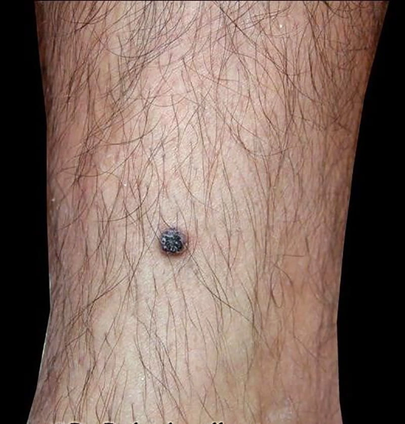 آنژیوکراتوم