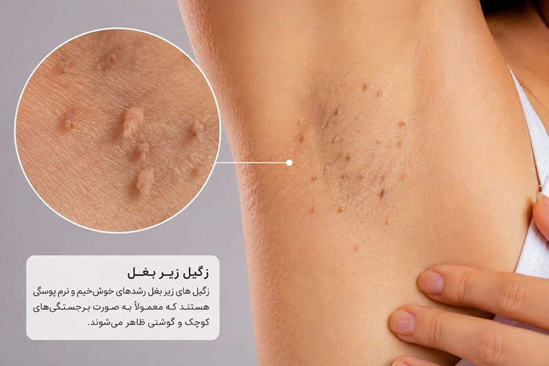 زگیل زیر بغل چیست و چرا به وجود می‌آید؟