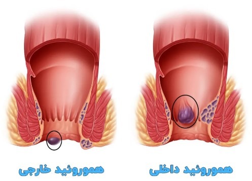 لیزر هموروئید بهتر است یا جراحی؟
