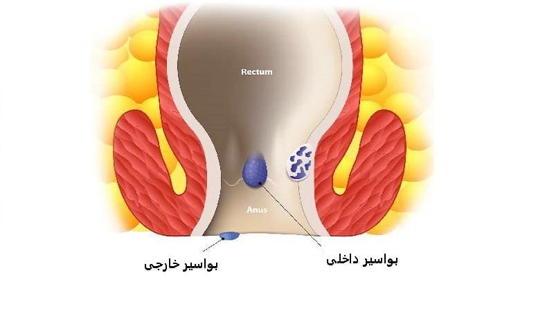 عوارض درمان نکردن بواسیر یا هموروئید چیست؟