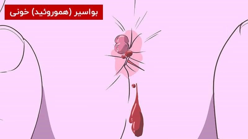 عوارض درمان نکردن بواسیر یا هموروئید چیست؟