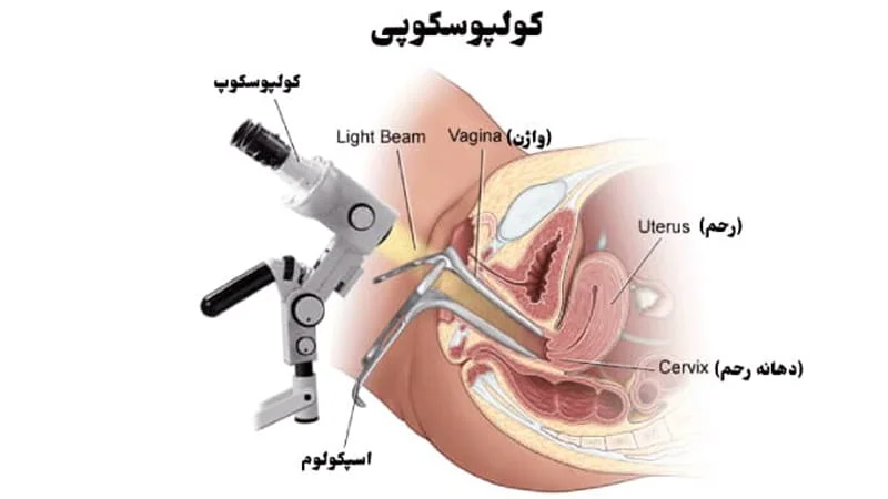 کولپوسکوپی زگیل تناسلی  چیست؟  نحوه انجام، کاربرد، هزینه و عوارض