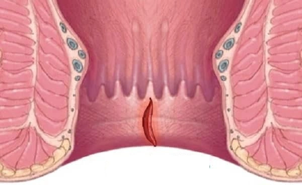 درمان شقاق در دوران بارداری چگونه است؟