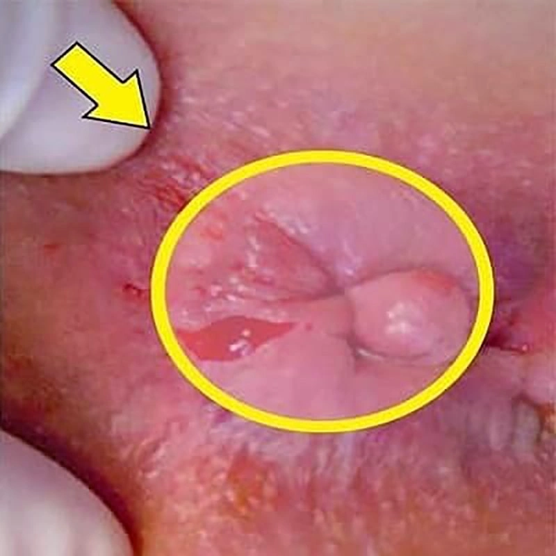 درمان شقاق در دوران بارداری چگونه است؟