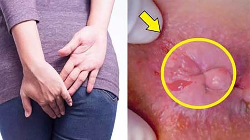 درمان شقاق در دوران بارداری چگونه است؟