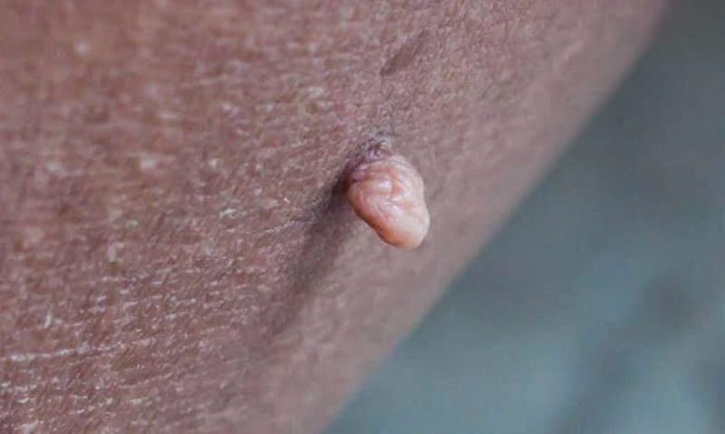 اسکین تگ تناسلی 