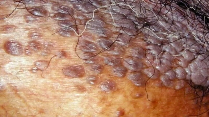 زگیل تناسلی بعد از چند وقت نمایان میشود؟