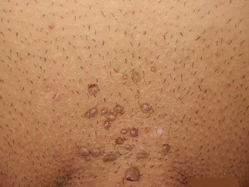 زگیل تناسلی بعد از چند وقت نمایان میشود؟