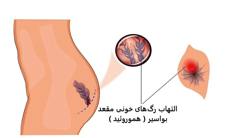 بهترین دکتر برای درمان بواسیر داخلی و خارجی در تهران کیست؟