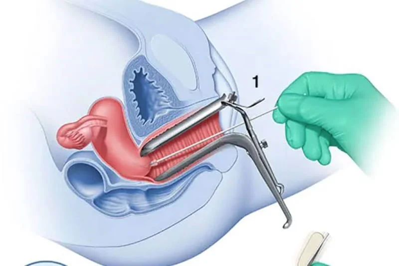 آزمایش بعد از درمان زگیل تناسلی hpv   