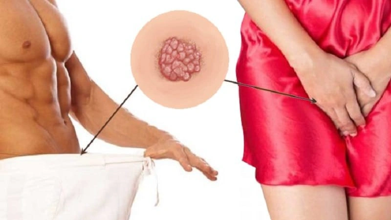 علت بوجود آمدن زگیل تناسلی در مردان و زنان چیست؟