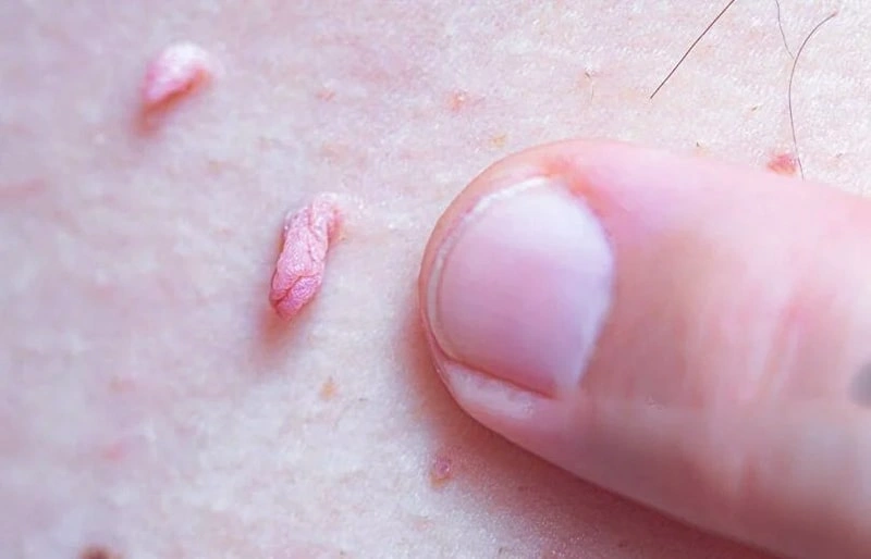 درمان زگیل تناسلی در کودکان چگونه است؟