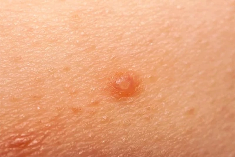 آدرمان زگیل تناسلی در کودکان چگونه است؟