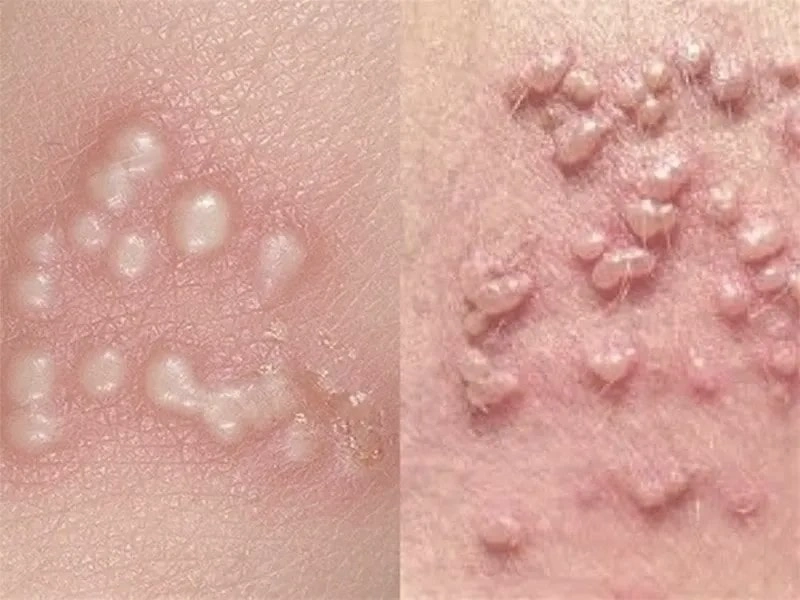 علت بوجود آمدن زگیل تناسلی در مردان و زنان چیست؟