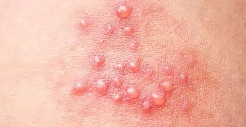 آدرمان زگیل تناسلی در کودکان چگونه است؟