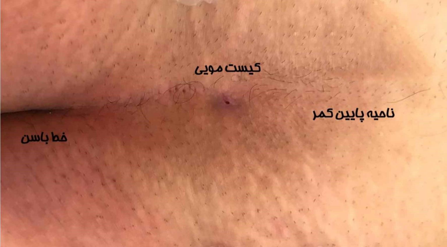 سریع ترین راه درمان کیست مویی چیست؟