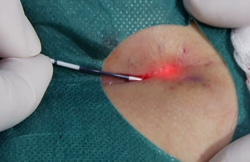 تفاوت جراحی باز و لیزر کیست مویی چیست؟