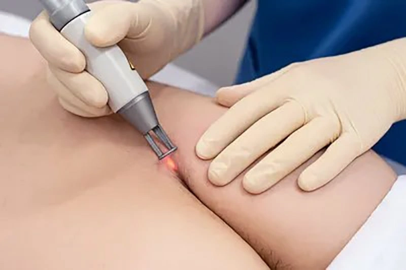 تفاوت جراحی باز و لیزر کیست مویی چیست؟