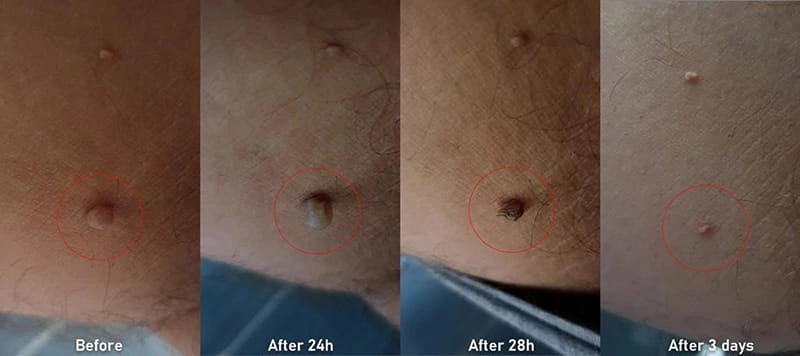 دوره نقاهت بعد از لیزر زگیل تناسلی  چگونه است؟