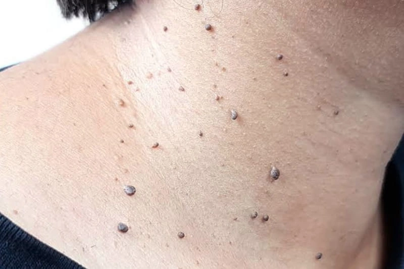 زگیل گردن چیست و چه شکلی دارد؟