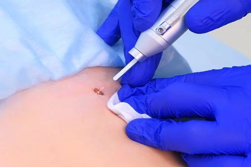 آیا بعد از لیزر زگیل تناسلی میتوان رابطه داشت؟