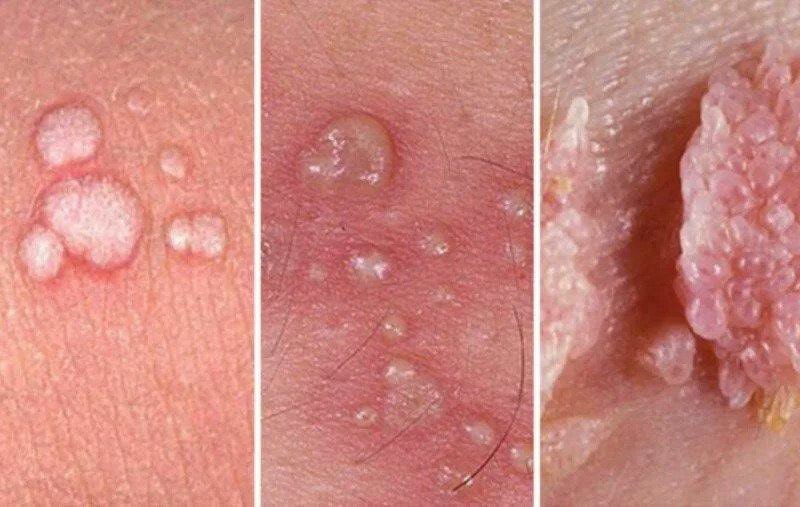 چطور بفهمیم زگیل تناسلی داریم؟