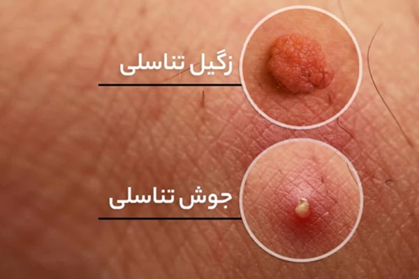 تفاوت زگیل تناسلی با جوش