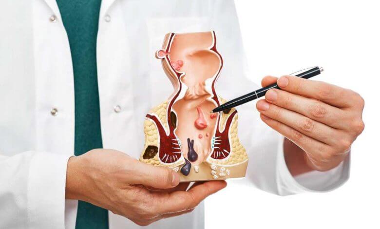 علائم بواسیر