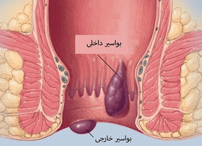 علائم بواسیر