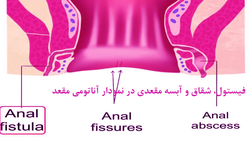 فیستول، شقاق و آبسه مقعدی در نمودار آناتومی
