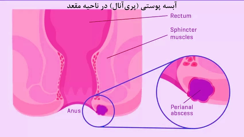 آبسه پوستی (پری آنال) در ناحیه مقعد